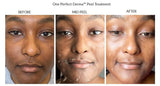 The Perfect Derma Peel Certificate Course